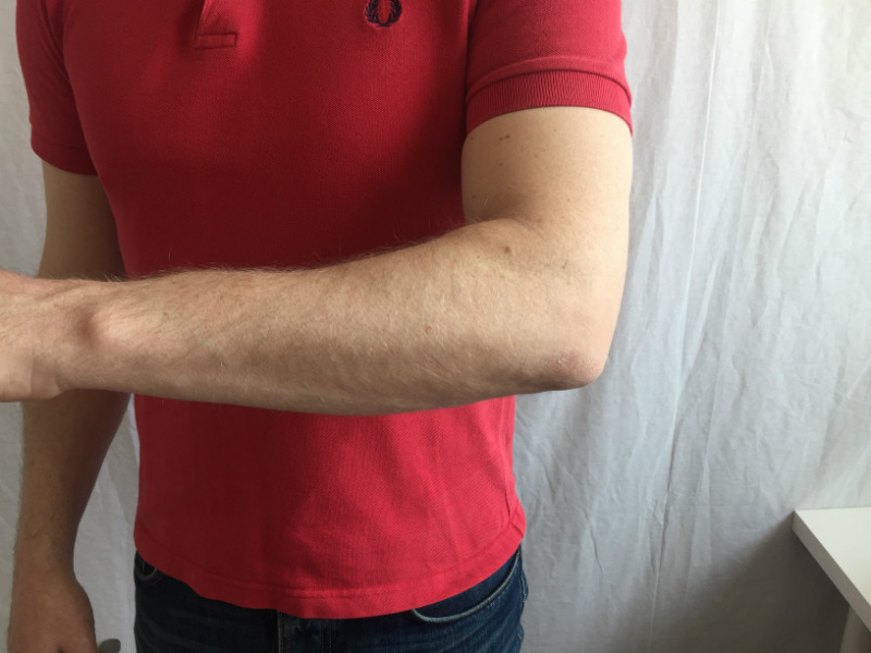 Tennisarmbåge instruktion stöd 1