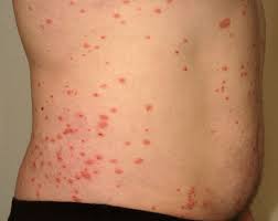 början på psoriasis början på psoriasis